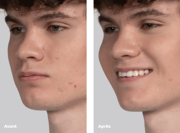 L'avant/après de l'utilisation du Foreo Espada