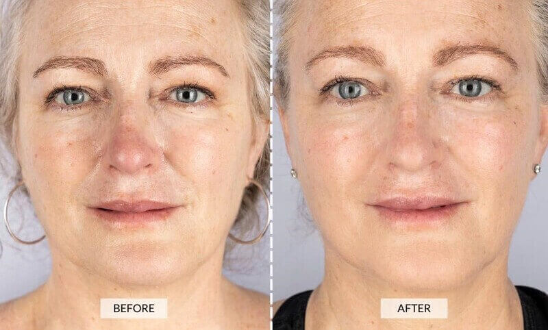 Photo avant après avec le masque LED visage et cou de Current Body (durée d'utilisation non indiquée)
