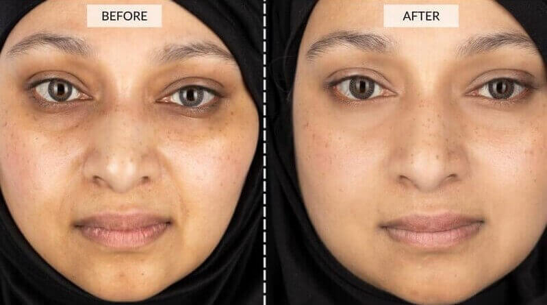 Photo avant après avec le masque LED Skin de Current Body (durée d'utilisation non indiquée) -