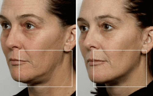 Avant après du visage de profil après le soin de 60 jours avec le NuFACE Trinity