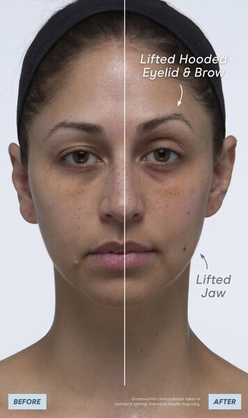 Avant après, après le soin de 60 jours avec le NuFACE Trinity - © NuFACE