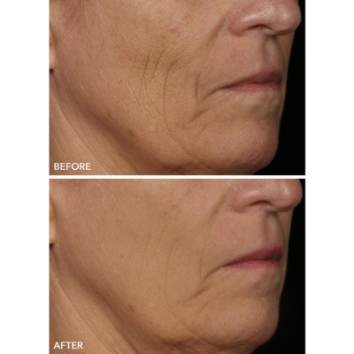 Avant après Dr Dennis Gross LED mask sur les rides