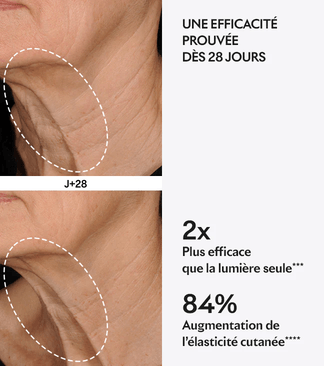 Avant après protocole Lift de Lightinderm