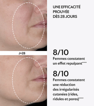 Avant après protocole Skin Perfect de Lightinderm