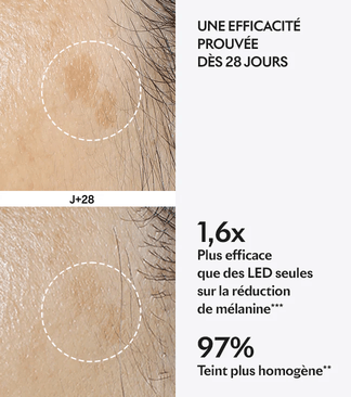 Avant après protocole Spotless de Lightinderm