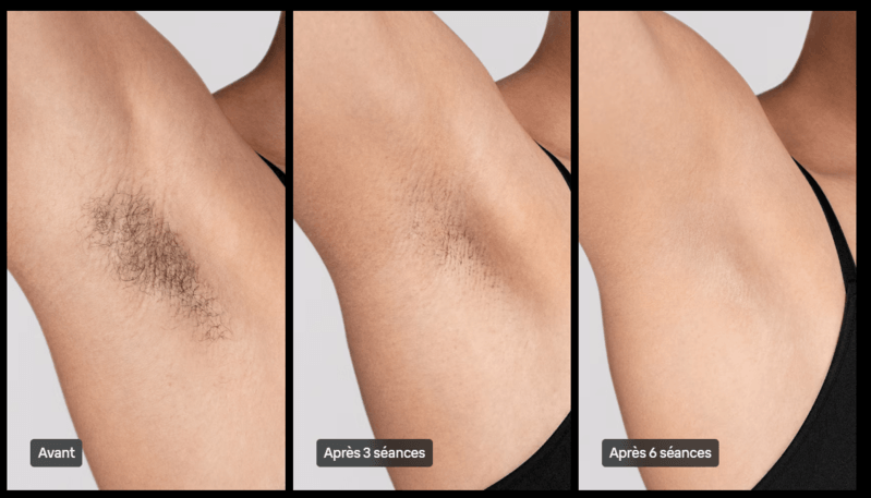 Résultats des aisselles au bout de 3 séances avec Braun Skin i-expert
