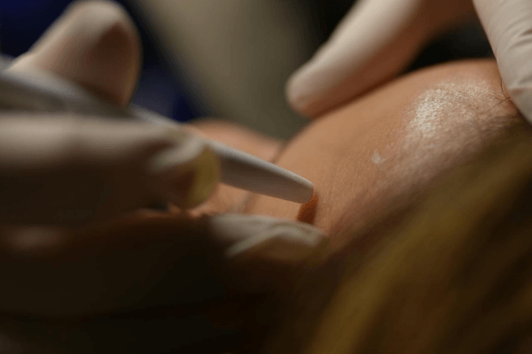 Microneedling : quels sont les véritables dangers et pour qui ce soin est-il déconseillé ?
