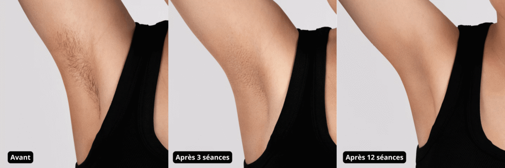 Avant après aisselles Braun Silk Expert Pro 3