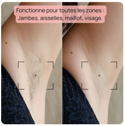 Résultats des aisselles avec le Bodysiam Elite