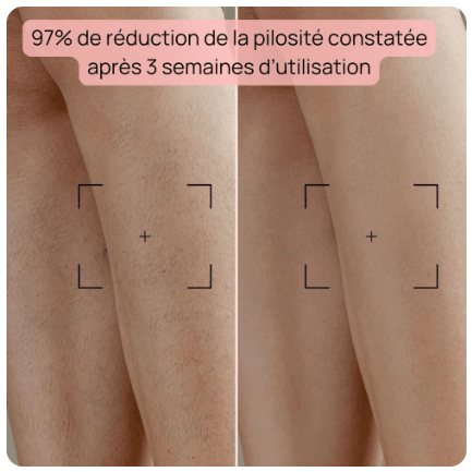 Résultats des cuisses avec le Bodysiam Elite