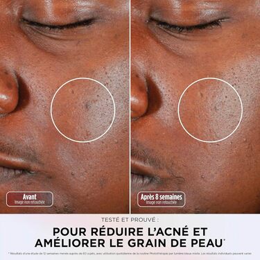 Masque Shark CryoGlow pour réduire l'acné