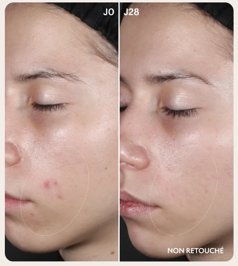 Lightinderm Purity avant après à 28 jours