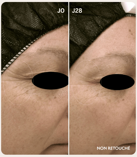 Lightinderm Repair avant après à 28 jours