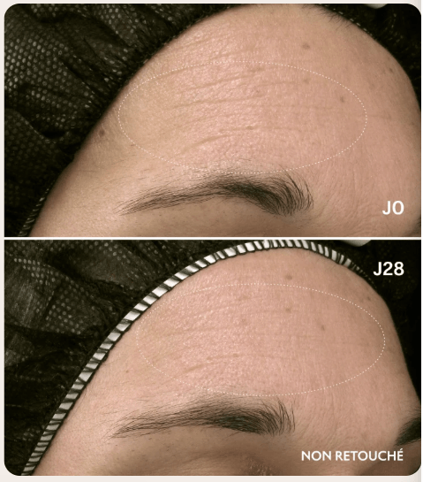 Lightinderm Repair avant après à 56 jours