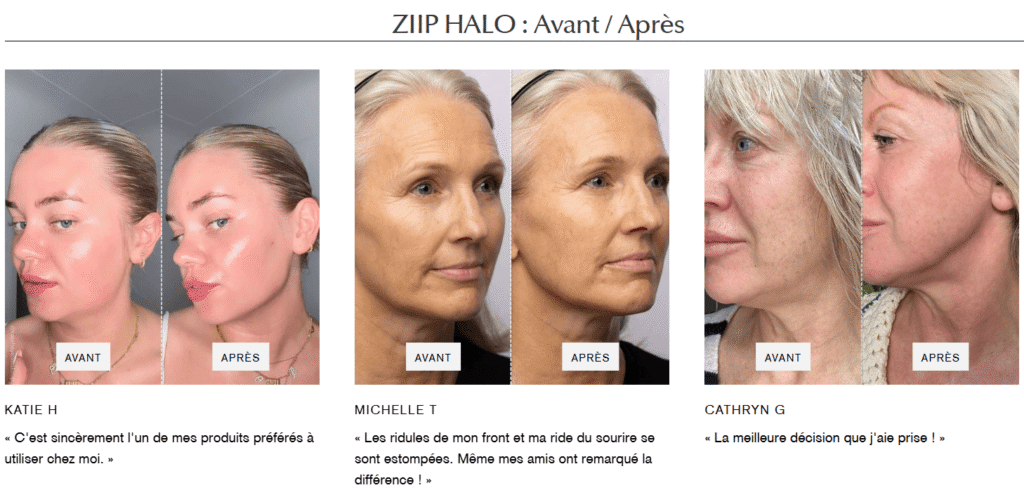 L'avant/après des utilisatrices du Ziip Halo